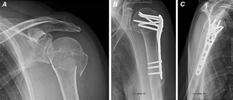 Figure 6 from Acute proximal humeral fractures in adults ...