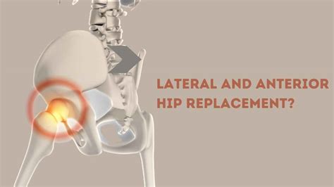 Direct Anterior Hip Replacement Anatomy