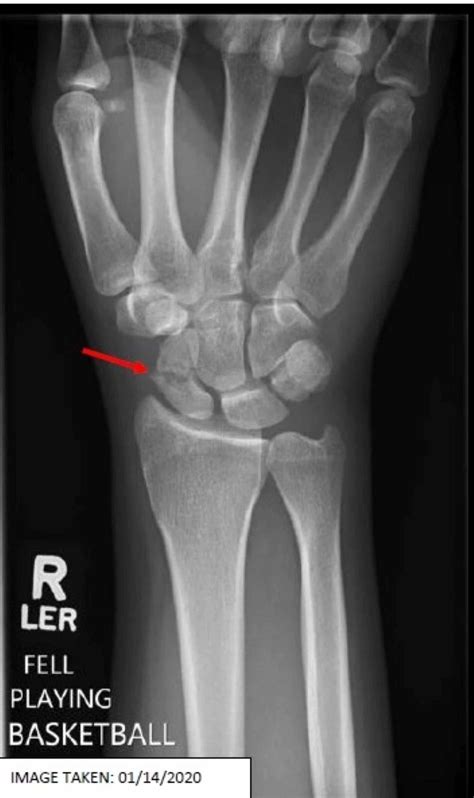 Scaphoid Bone Fracture Rightnetworking