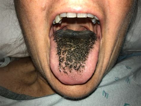 Black Hairy Tongue What Is It And How Do You Get It