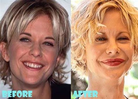 Meg Ryan Plastic Surgery Before And After Shocking Facelift Plastic