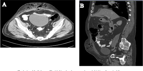 figure 1 from small bowel diverticulum complicated by enterocutaneous fistula and abdominal wall