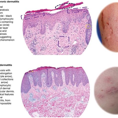 Morphologic Phenotypes A Nummular Discoid Dermatitis B Prurigo