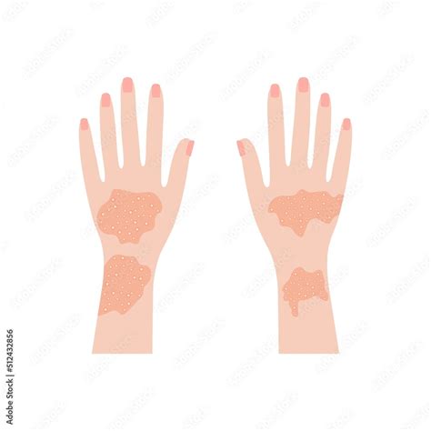 Human Hands With Psoriasis And Rashes Red Eczema Eruptions And
