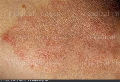 Stock Image Dermatology Psoriasis Extensive Dry Pink And Scaly Skin On
