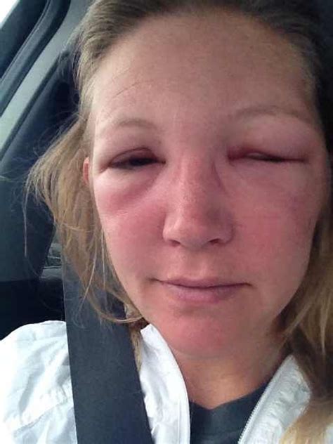 Bee Sting Swelling Face