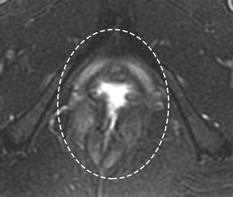 Imaging And Surgical Management Of Anorectal Vaginal Fistulas