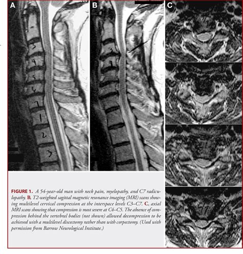 Figure 1 From Four‐level Anterior Cervical Discectomy And Fusion With