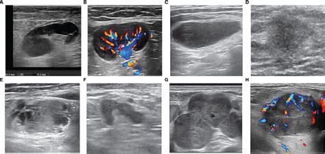 Frontiers Diagnostic Model Of Superficial Lymph Nodes Based On