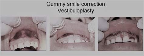 Gummy Smiles Medical Orofacial Surgery