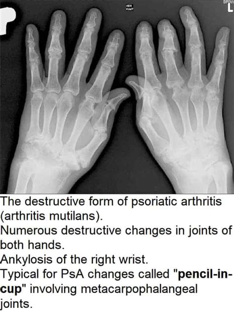 Psoriatic Arthritis