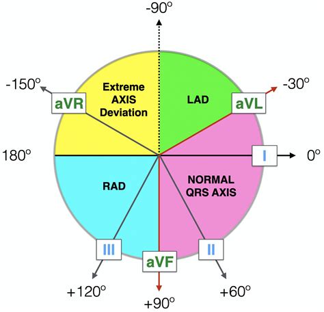 Right Axis Deviation Rad • Litfl • Ecg Library Diagnosis