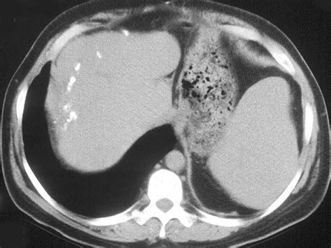 Ct And Mri Of Hepatic Abscess In Patients With Chronic Granulomatous