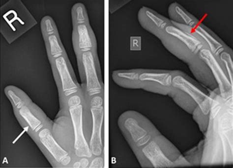 An Unusual Cause Of Finger Swelling Bmj Case Reports