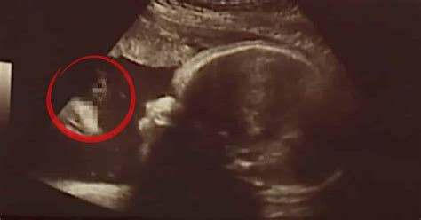 Can A Gender Ultrasound Be Wrong Mommyish