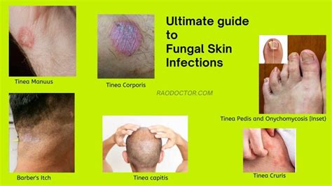 Ultimate Guide To Fungal Skin Infections How To Tackle Them