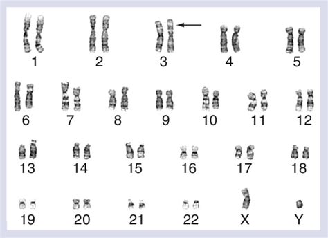 Karyotype By Trypsin And Wright Stain Banding Representing Mesenchymal