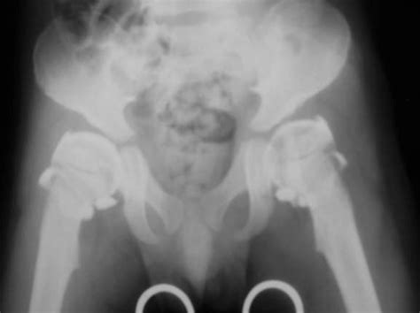 An Anteroposterior View Of The Hips A In A Patient With Mps I After