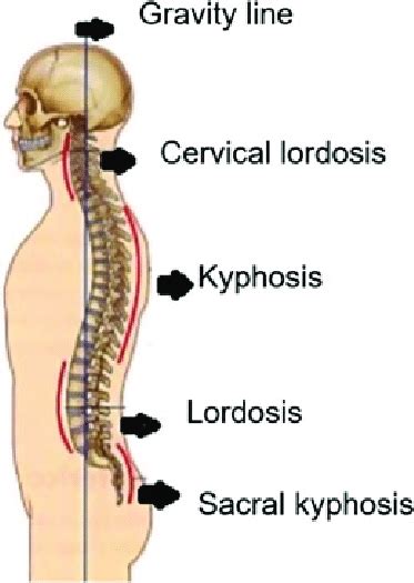 Schematic Representation Of The Kyphosis And Lordosis Pathologies Download Scientific Diagram