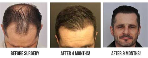 After hair restoration, the hair growth timeline requires patience. Top Hair Transplant Results Depend on *You* During ...