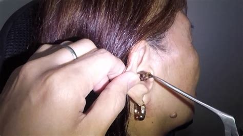 Watch How To Remove Stuck Insect Inside The Ear Youtube
