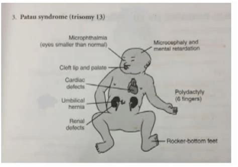 Why Patau Syndrome Or Known As Trisomy 13