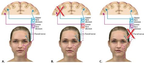The weakness makes half of your face appear to droop. 17 Best images about Neuro on Pinterest | Pathways, Search ...