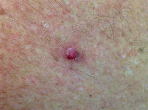 A Guide To Skin Cancers Saga