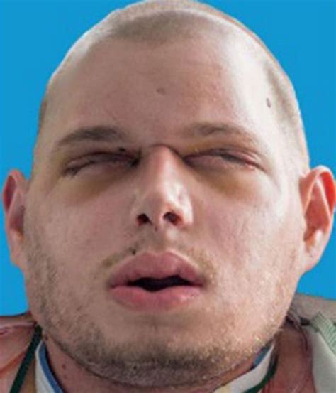 See Amazing Step By Step Transformation Of Ex Firefighter S Face Transplant After Horrific Burns