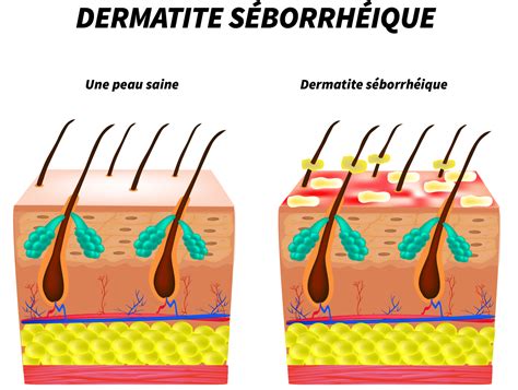 Dermatite Séborrhéique Causes Symptômes Et Traitements Information