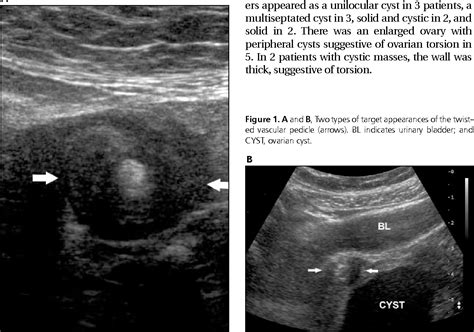 Figure 1 From Sonographic Whirlpool Sign In Ovarian Torsion Semantic