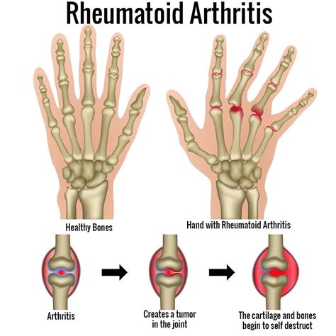 Rheumatoid Arthritis Causes Signs Symptoms Diet Treatment