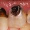 Meth Mouth Inside Look At Icky Problem Graphic Images Photo