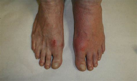 Diabetic Foot Rash Pictures Symptoms And Pictures