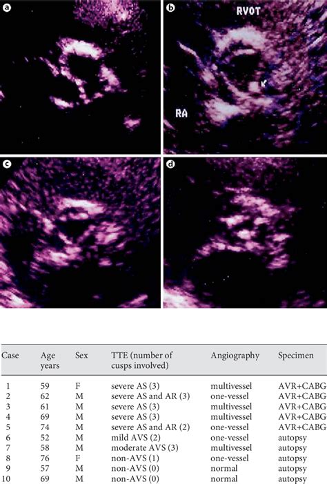 Figure 1 From A High Association Of Aortic Valve Sclerosis Detected By