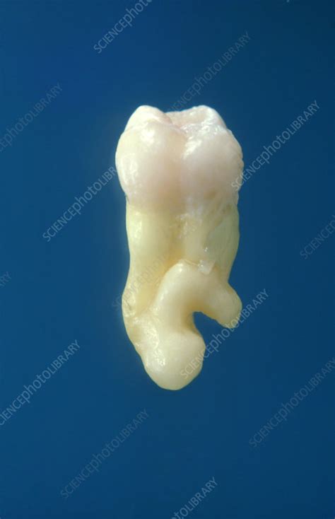 Wisdom Tooth With Abnormal Root Stock Image M7800020 Science