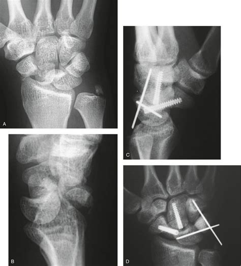 Perilunate Injuries Of The Wrist Clinical Gate
