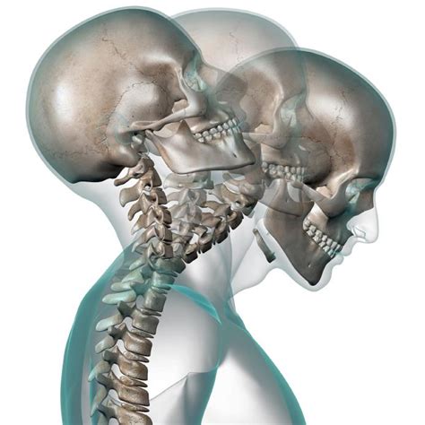Vértebras cervicales y estructuras de soporte. Latigazo cervical - Columna Vertebral