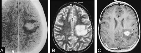 Early Cerebritis Phase In Post Contrast Ct A T2wi B And