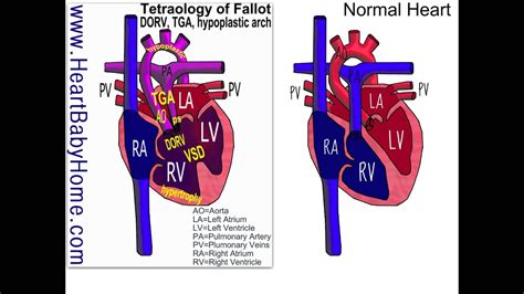 Heart Defect 29 Tetralogy Of Fallot Tga Dorv Vsd Hypoplastic Arch