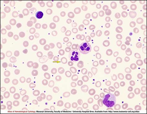 Iron Deficiency Anaemia Cell Atlas Of Haematological Cytology
