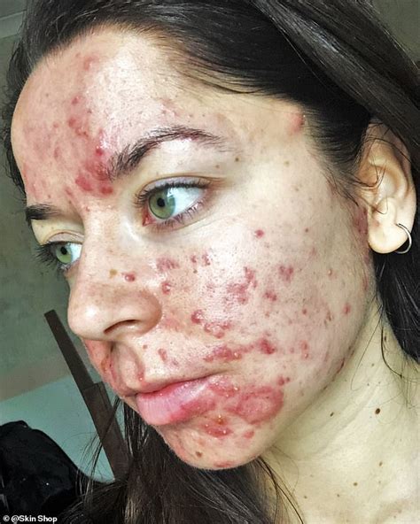 Woman Bullied At School Due To Acne Has Seen Dramatic Improvements