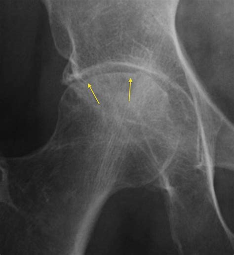 Avascular Necrosis Subchondral Collapse Radiology At St Vincent S