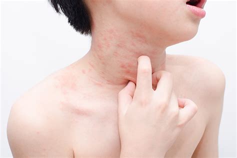 Skin Rashes In Children Causes Treatment And Prevention