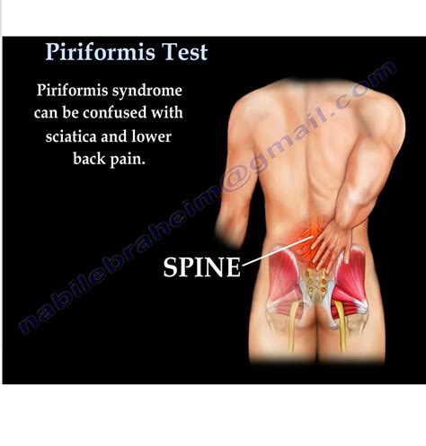 Piriformis Syndrome Orthopaedicprinciples Com