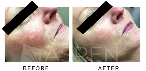 Mequon Photofacial Ipl Laser Therapy