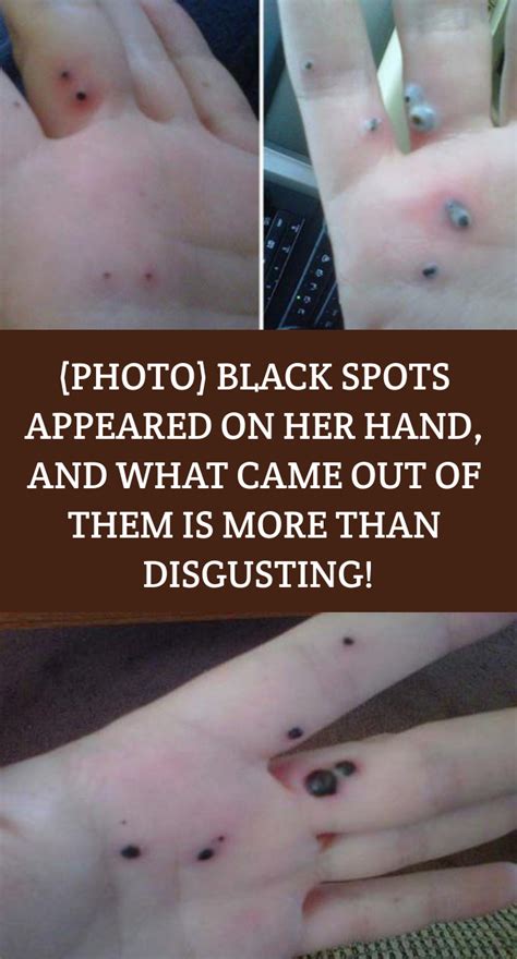 Photo Black Spots Appeared On Her Hand And What Came Out Of Them Is