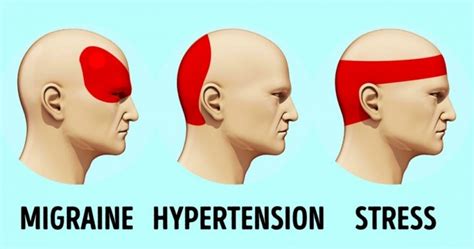 Causes, prevention, and how to get rid of them. 6 Pressure Points for Headaches that Provide Relief in ...