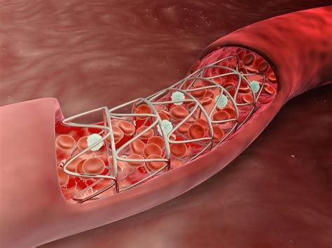 Stents Types Uses Side Effects And Risks