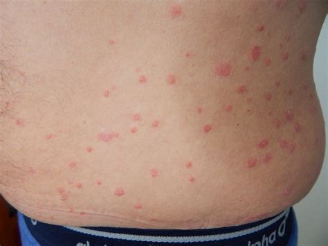 Dermatopathology Made Simple Inflammatory Psoriasiform Reaction Pattern